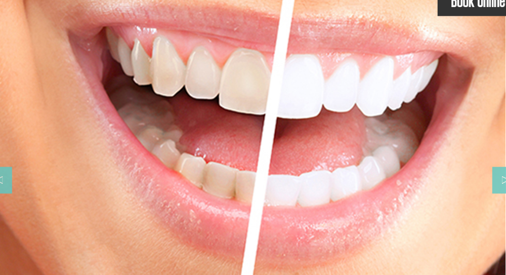 LASER TEETH WHITENING